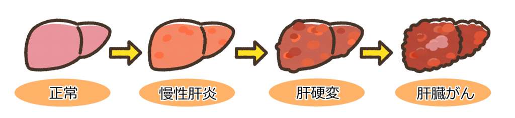 肝がんまでの経過